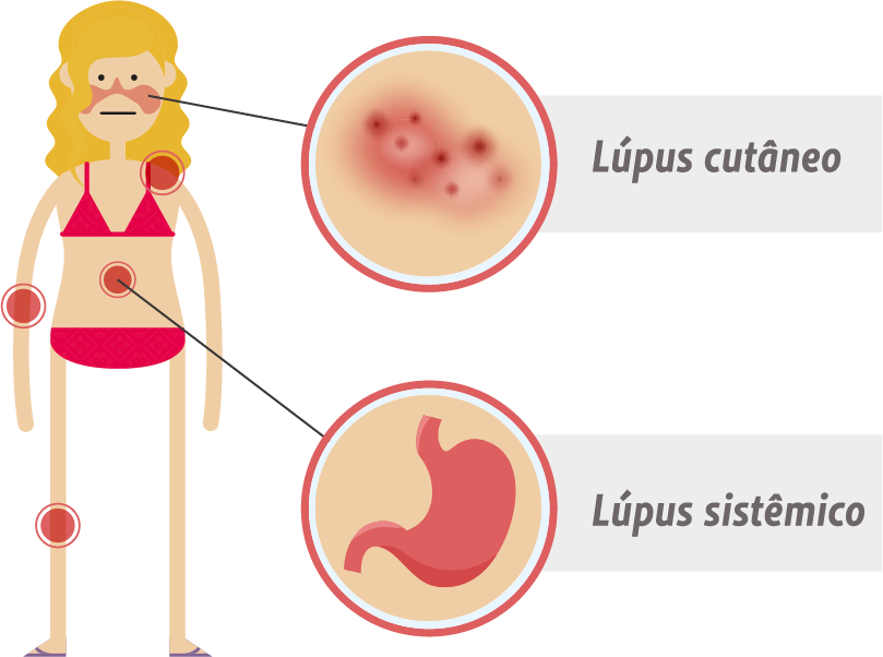 Lúpus: o que é, sintomas e como conviver com a doença - Saúde em Pauta - Institucional