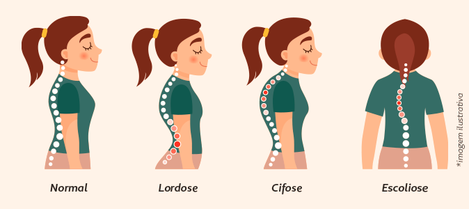 Ilustração que mostra as diferenças entre a coluna vertebral normal e as afetadas pelos problemas posturais