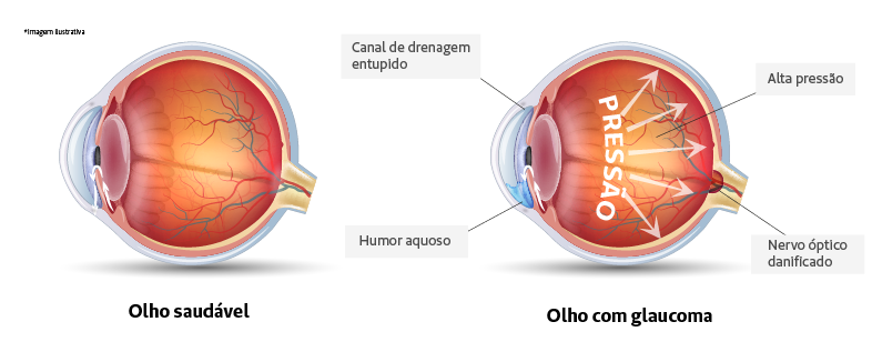Olho saudável x olho com glaucoma (imagem ilustrativa)
