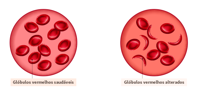Anemia Falciforme Entenda O Que é E Como Cuidar Saúde Em Pauta Unimed Itaúna 
