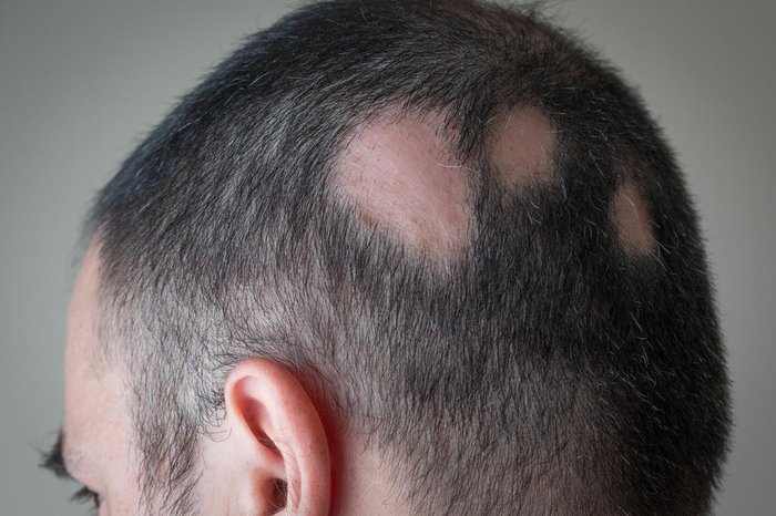 queda de cabelo devido a alopecia aerata